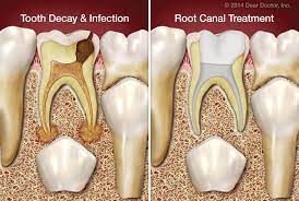 Root Canal Treatment